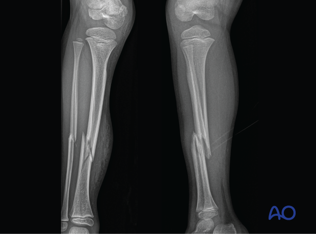 AP and lateral x-rays of a pediatric tibial shaft fracture with an associated fibular shaft fracture