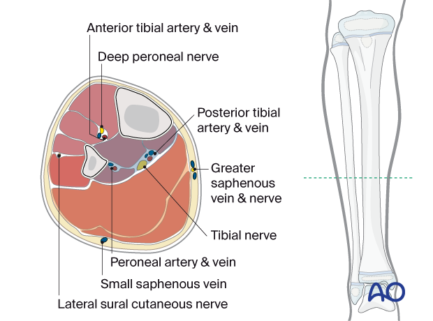 Cross-section of the pediatric lower leg showing the neurovascular structures