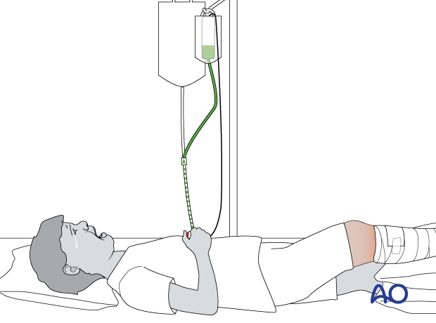 Crying child with emerging compartment syndrome in the lower leg