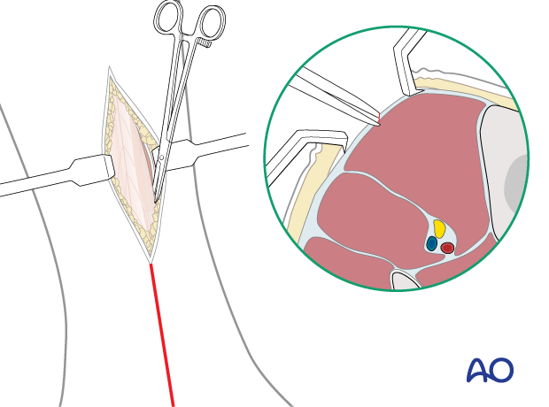 Fascia dissection of the anterior compartment of the pediatric lower leg