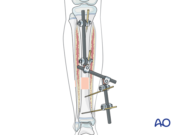 Open medial and lateral skin incisions after fasciotomy with an applied modular external fixator for fracture stabilization