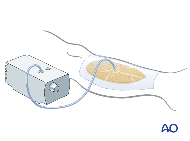 Vacuum-assisted closure after fasciotomy in the lower leg