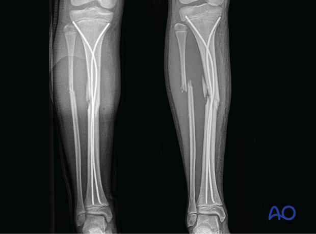 X-rays showing a fracture of the tibial and fibular shaft in an adolescent fixed with elastic nailing which failed in stabilizing the fracture