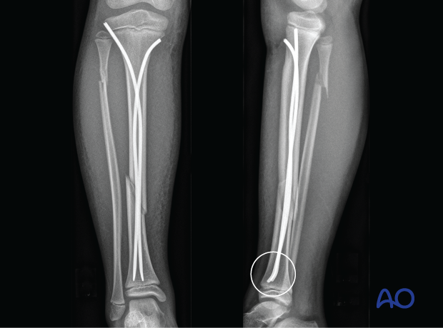 X-rays showing an oblique tibial shaft fracture treated with elastic nailing