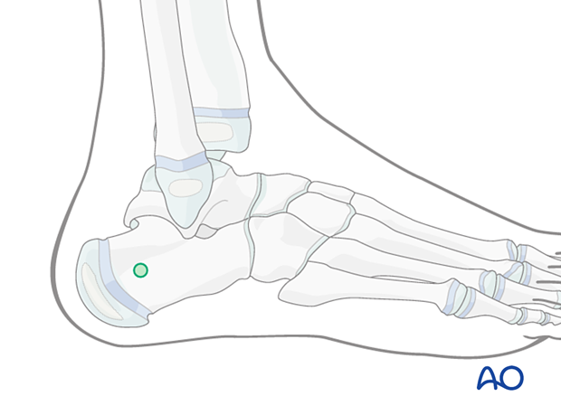 Pin placement in the pediatric calcaneus