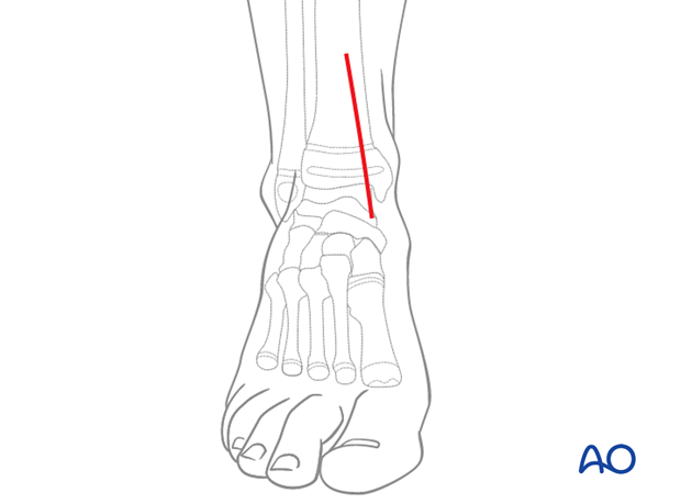 Skin incision for an anteromedial approach to the pediatric distal tibia