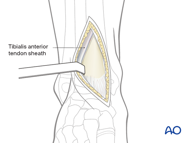 Surgical dissection to the periosteum of an anteromedial approach to the pediatric distal tibia