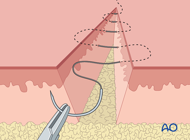 Subcuticular absorbable skin sutures