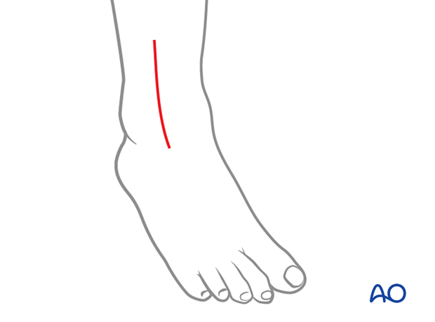 Skin incision for the anterolateral approach to the pediatric distal tibia