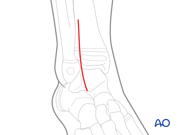 Skin incision for the anterolateral approach to the pediatric distal tibia