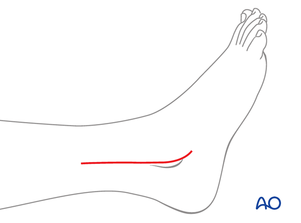 Skin incision for a lateral approach to the pediatric distal fibula