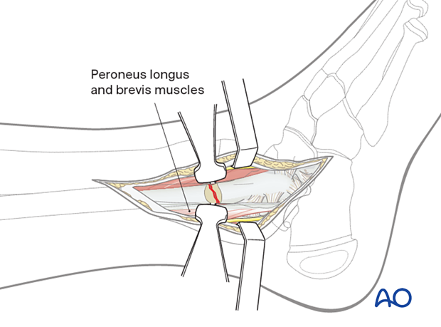 Surgical dissection to the pediatric distal fibula