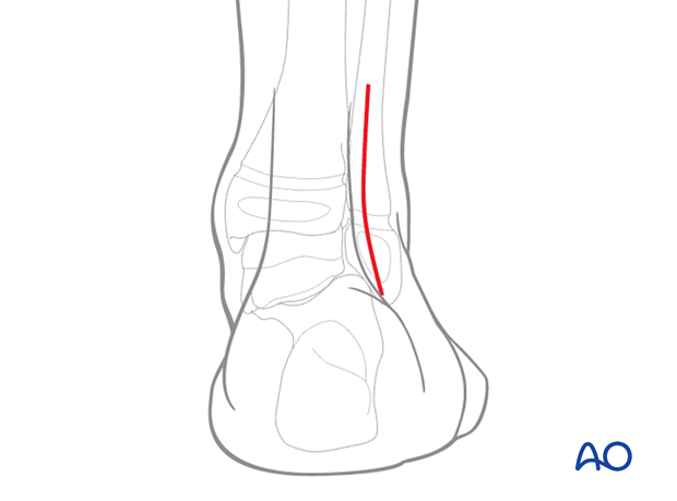 Skin incision for the posterolateral approach to the pediatric distal tibia