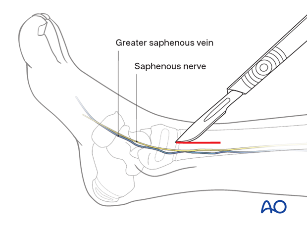 Skin incision of a minimally invasive approach for plating of the pediatric distal tibia