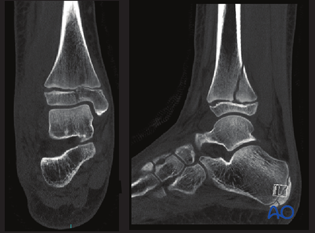 CT images showing a triplane fracture of the pediatric distal tibia