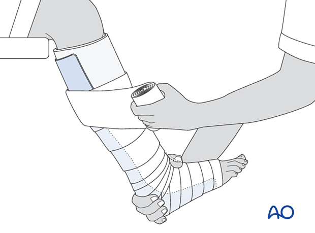 Application of a short leg splint