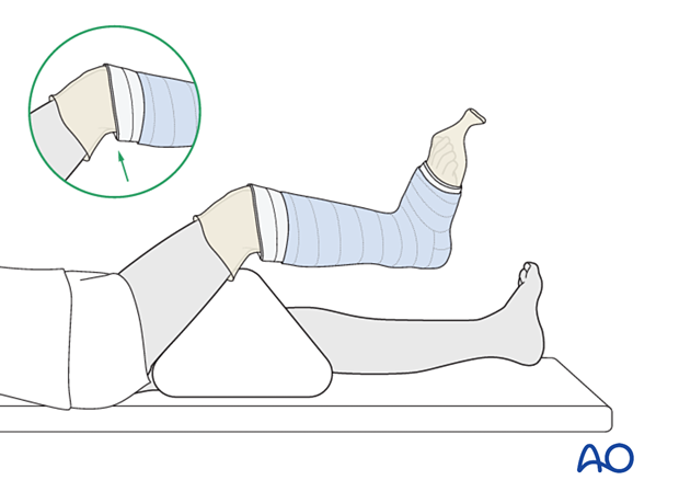 Cast application for short leg cast