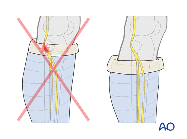 Avoiding pressure over the fibular head and neck with application of a short leg cast