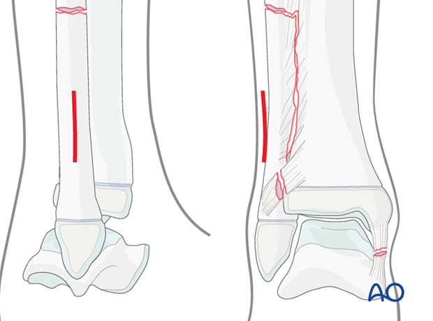 Lateral skin incision for syndesmotic transfixation