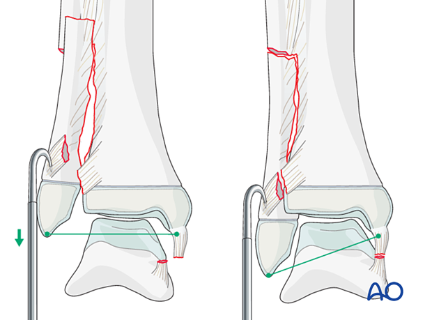 Reduction of a syndesmotic injury