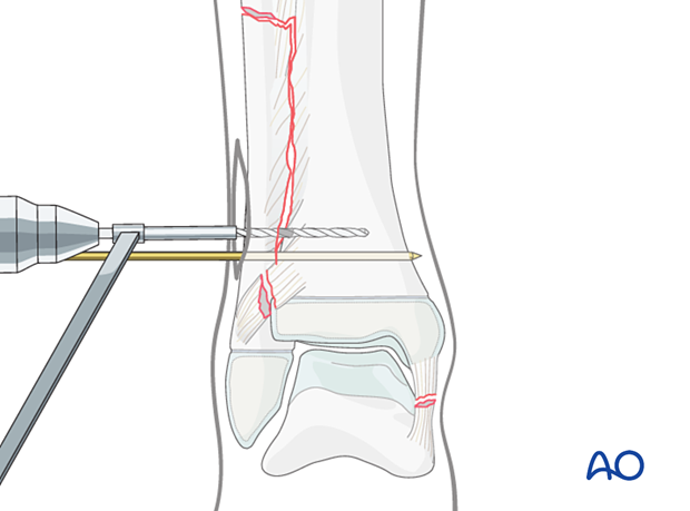 Drilling for syndesmotic transfixation