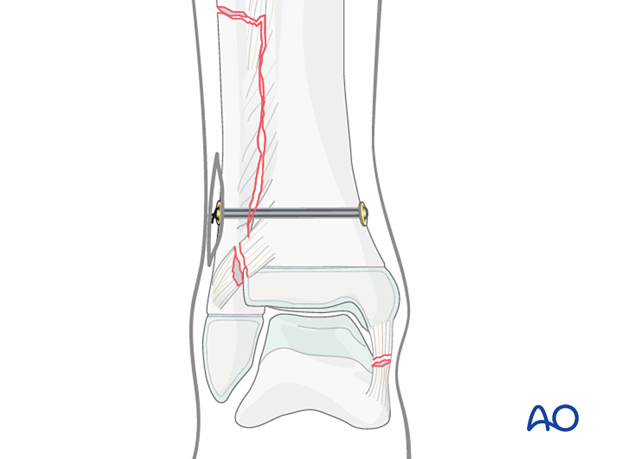 Syndesmotic transfixation with suture and button