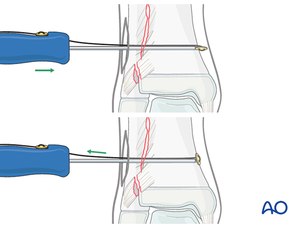 Syndesmotic transfixation with suture and button