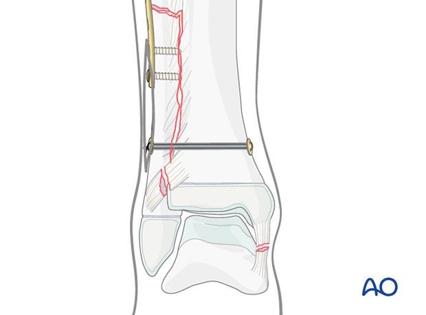 Syndesmotic transfixation with suture and button and plating of a diaphyseal fibular fracture