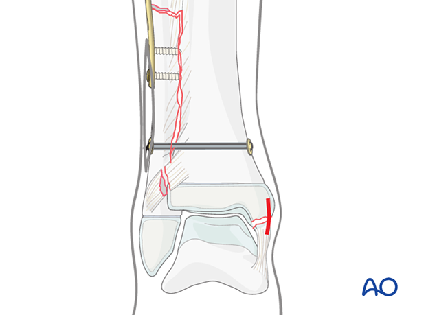 Incision over the medial malleolus