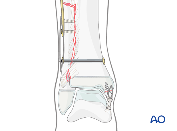 Medial collateral ligament reattachment in a syndesmotic injury