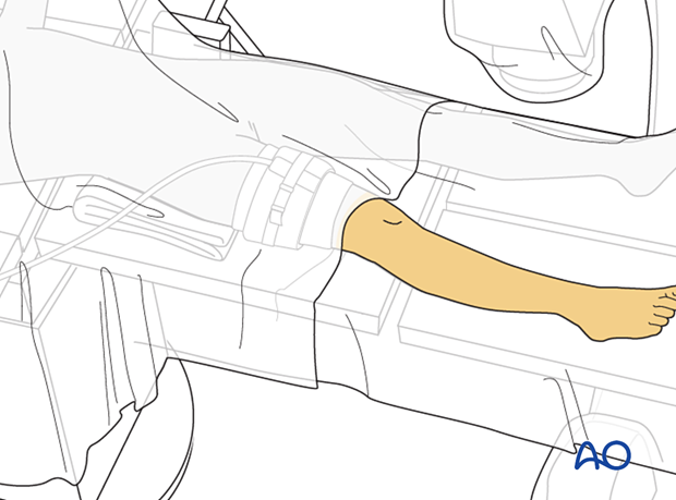 Skin preparation and draping of the leg of a pediatric patient in supine position