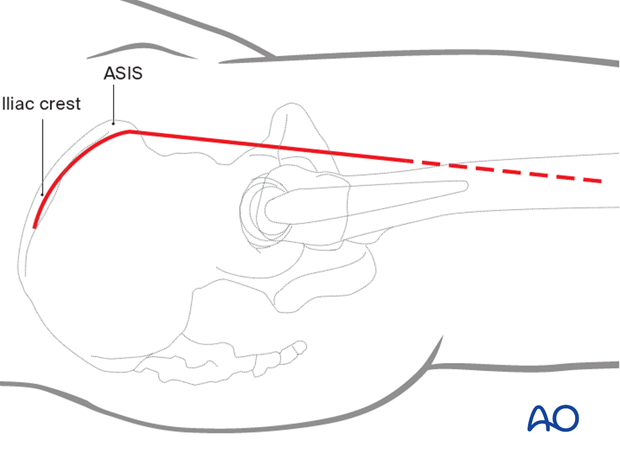 The skin incision for anterior approach begins over the lateral iliac crest and follows it to the anterior superior iliac spine