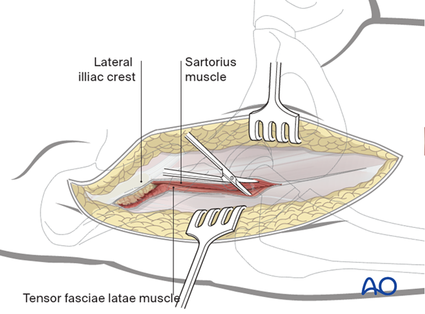 Release the abductor muscles from the lateral iliac crest and deepen the incision anteriorly, along the lateral border of ...