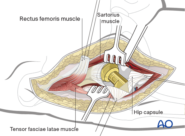 A T-shaped incision, with retention sutures medially and laterally, allows exposure of the femoral head and neck