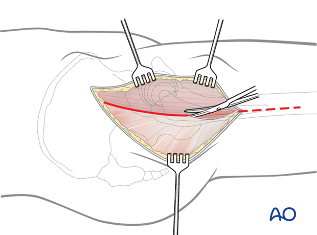 Incise the fascia lata over the femur and extend this incision proximally along the posterior border of the tensor fascia lata