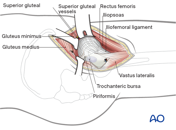 Place a Hohmann retractor into the bone proximal to the hip capsule