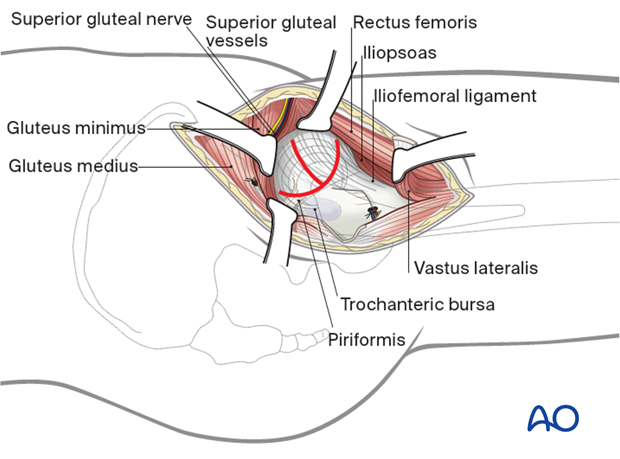 Make a T-shaped incision in the capsule