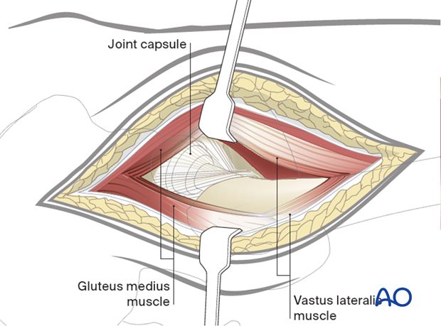 Deepen the incision through the gluteus medius and minimus proximally, retracting the anterior flap to show hip capsule