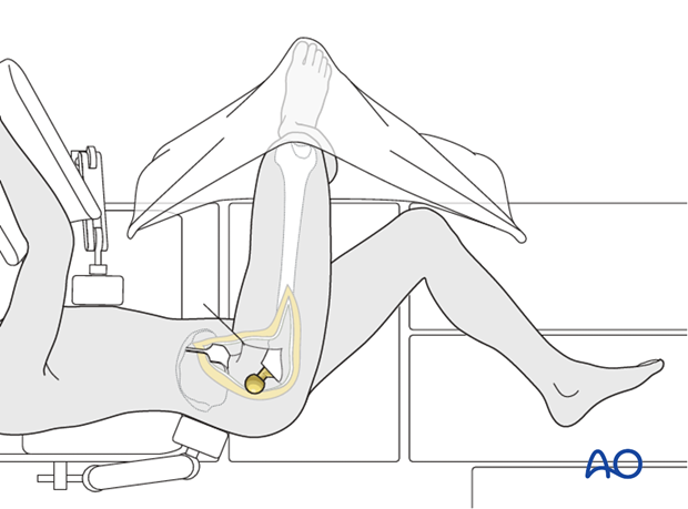 Exposure of the proximal femur is gained by gentle external rotation of the leg. The lower leg is placed into a pocket made ...