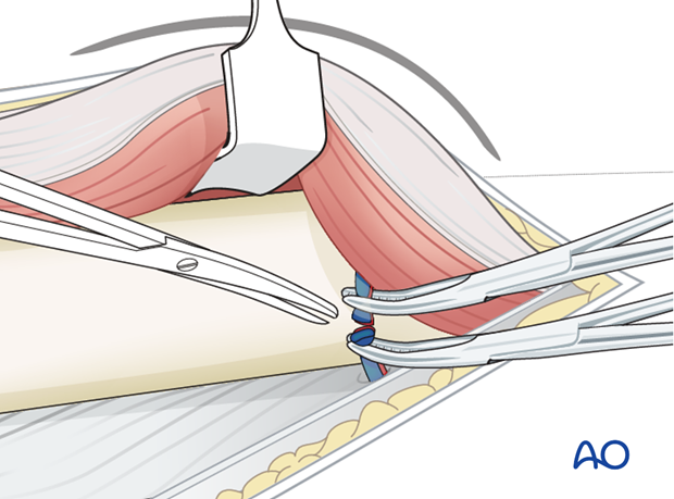 Ligation of perforating vessels