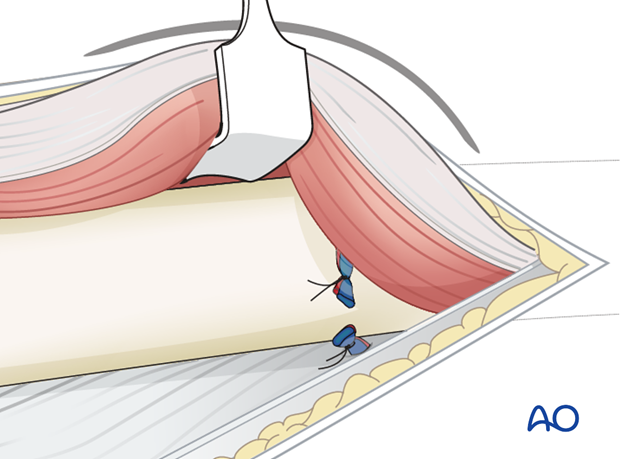 Ligation of vessel bundles