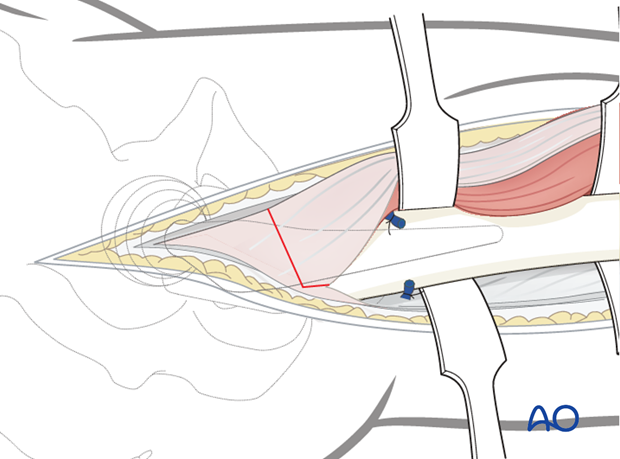 Exposure of proximal femoral shaft