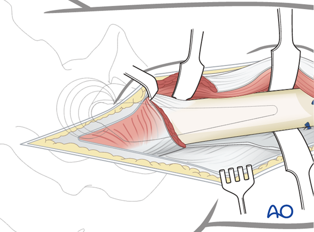 Detachment of vastus lateralis