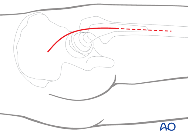 Skin incision