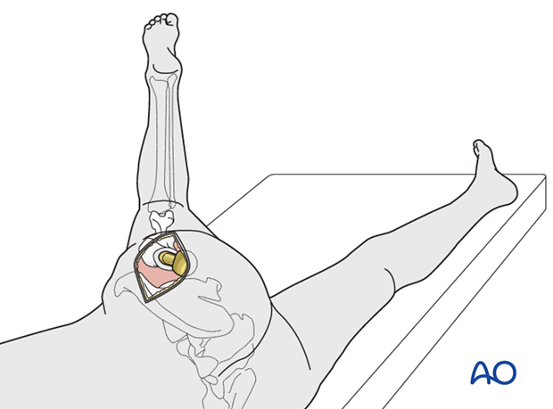 After posterior capsulotomy, the hip is dislocated with internal rotation