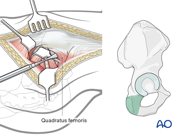 Additional caudal exposure in a Kocher-Langenbeck approach to the hip