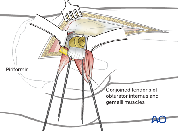 Hip joint exposure in a Kocher-Langenbeck approach