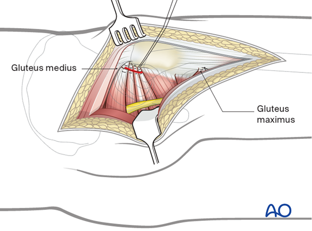 Capsule and tendons repair in a Kocher-Langenbeck approach to the hip