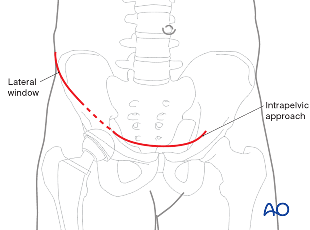 Skin incision for an anterior intrapelvic approach