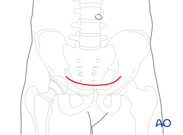 First skin incision for an anterior intrapelvic approach